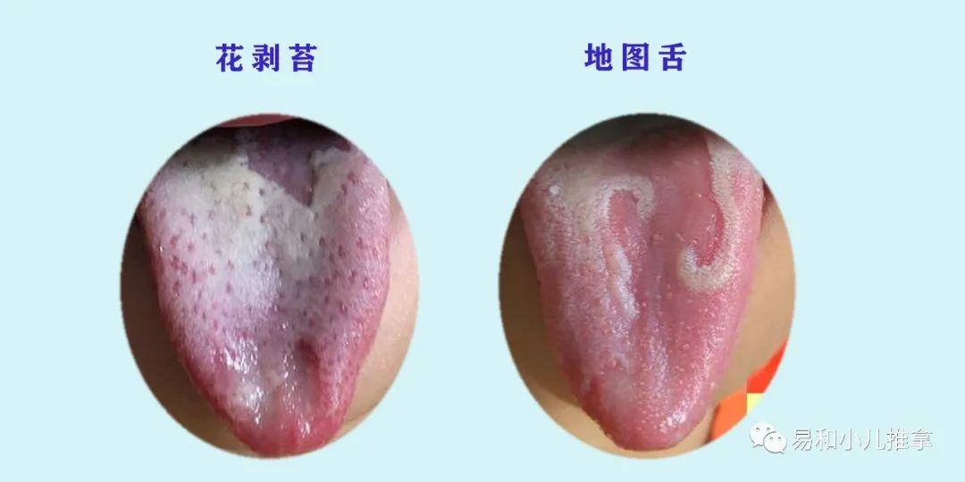 花剥苔——剥在舌苔上地图舌——剥在舌质上舌归五脏,苔属六腑舌苔~胃